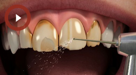 Porcelain Veneers